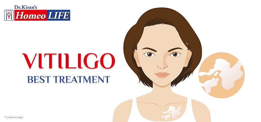 Vitiligo Homoeopathic Medicine|Homeopathy For Vitiligo